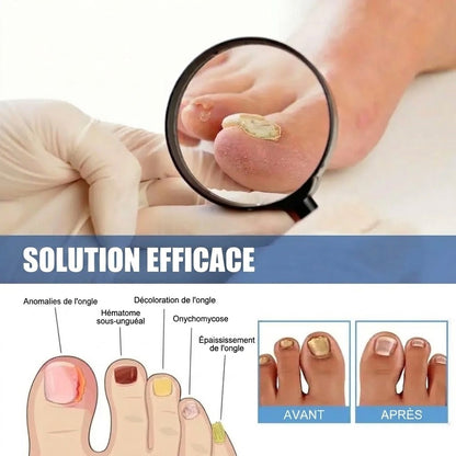 SilkEase™ Patchs Antifongiques pour Ongles & Kit de Soin