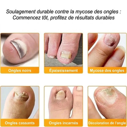 SilkEase™ Patchs Antifongiques pour Ongles & Kit de Soin